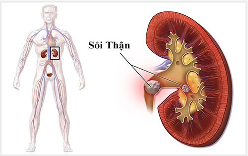 bệnh sỏi thận